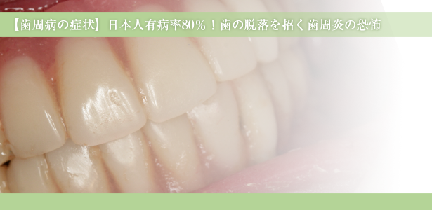 【歯周病の症状】日本人有病率80％！歯の脱落を招く歯周炎の恐怖